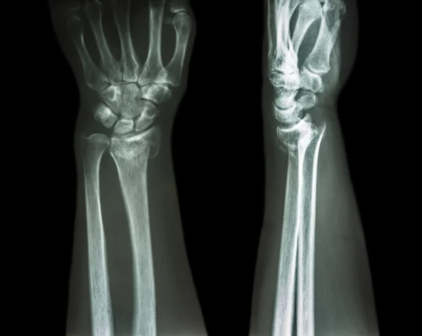 fractura de colles inspira fisio igualada